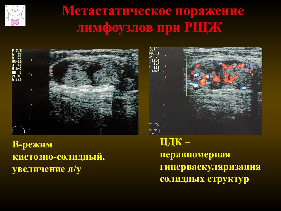 Образование в щитовидной железе. ЦДК гиперваскуляризация щитовидной железы. Солидное образование в щитовидной железе. Метастатическое поражение лимфоузлов. Кистозно солидная структура щитовидной.