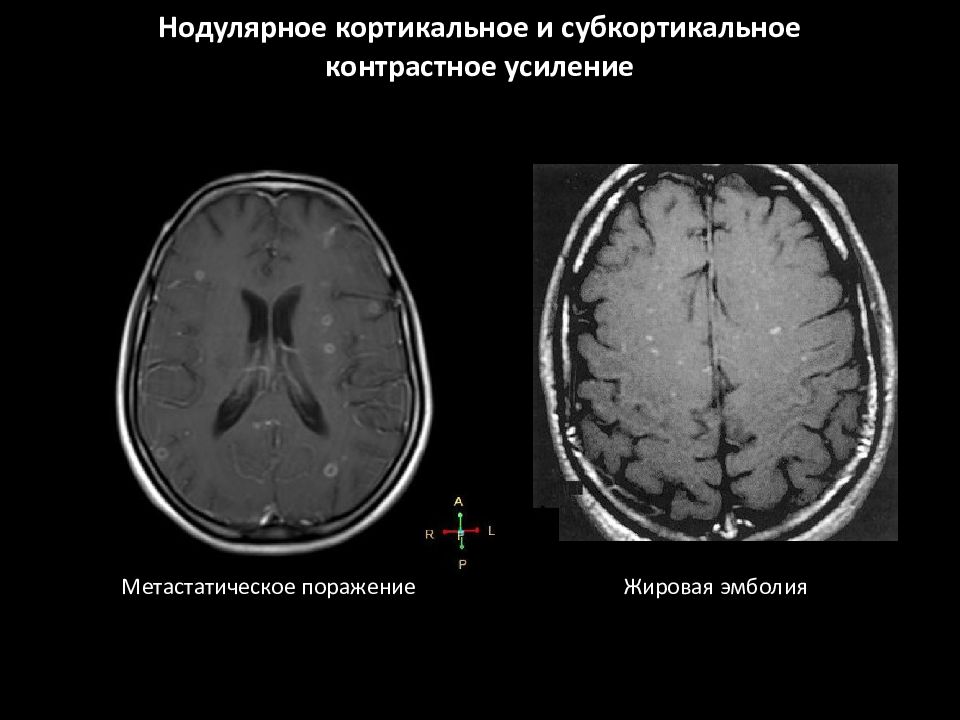 Контрастное мрт. Кортикальная дисплазия мрт. Кортикальный инсульт на кт. Кт с контрастным усилением. Контрастное усиление при кт.