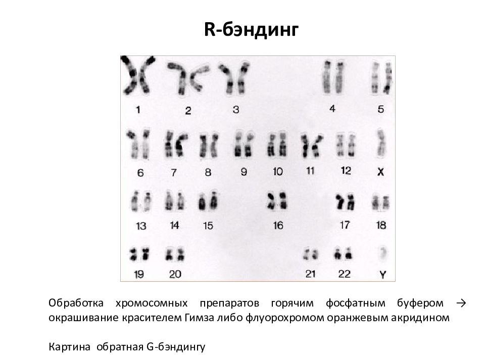 Метод хромосом. Бэндинг хромосом. Окраска хромосом по Гимзе. R Бэндинг хромосом. Методика g Бэндинг.
