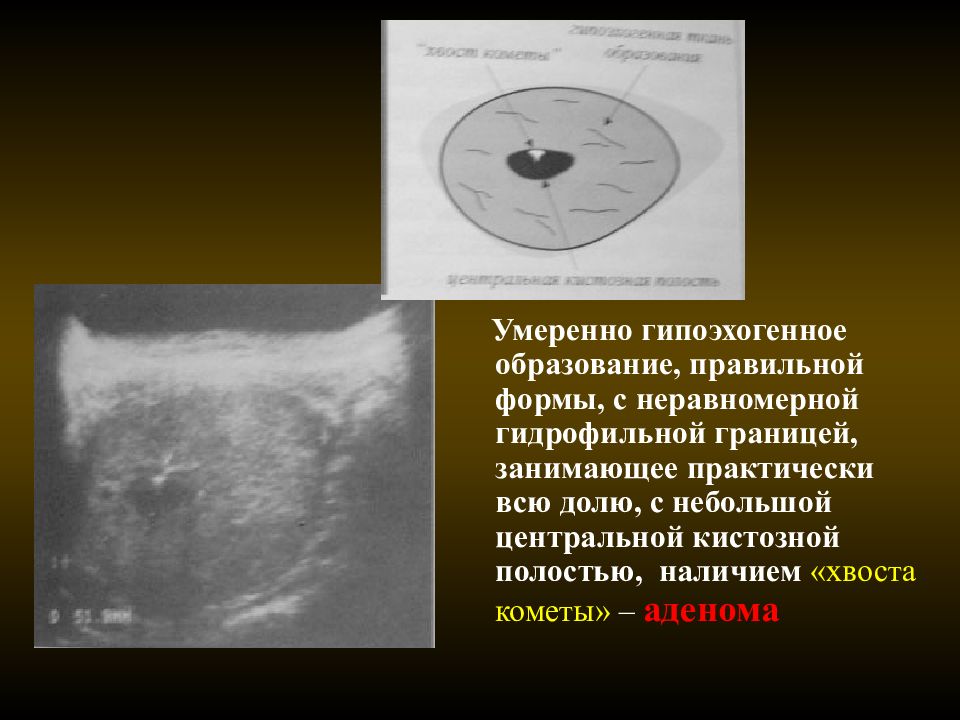 Гипоэхогенный щитовидной железы. Гипоэхогенные образования. Гипоэхогенное образование. Гипоэхогенные образования щитовидной железы. Гипоэхогенные образования в молочной железе.