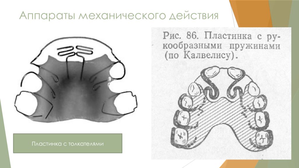 Действия аппарата. Механически действующие ортодонтические аппараты. Пластинка с толкателями ортодонтия. Аппараты механического действия.