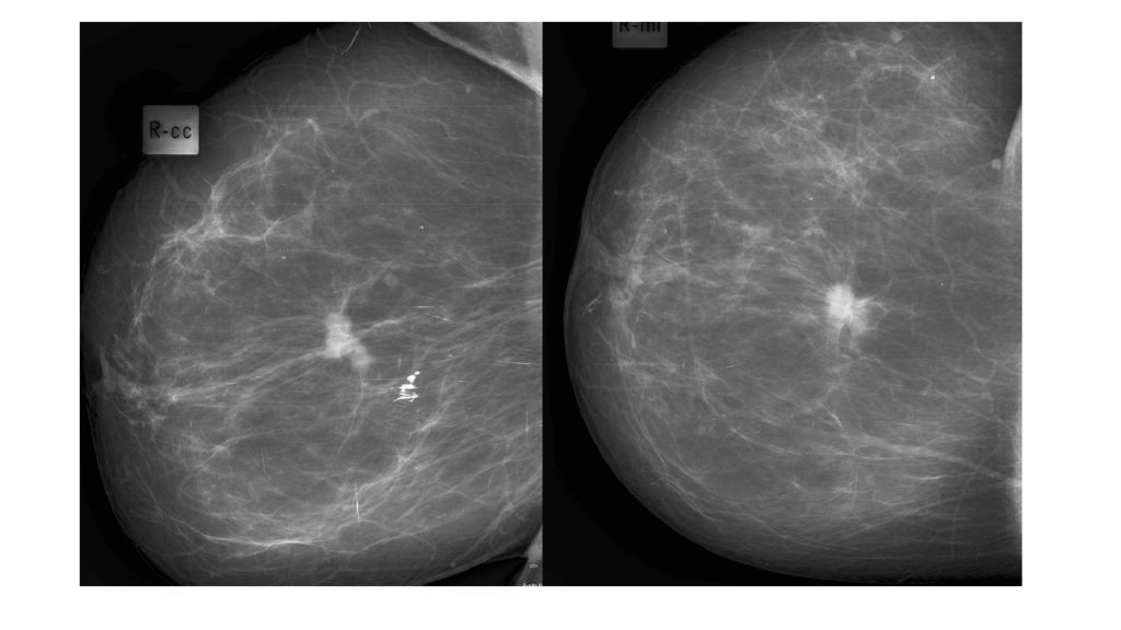 Солидное образование молочной железы. Злокачественные образования молочной бальзенома. Как на снимке маммографии выглядит доброкач и злокач.