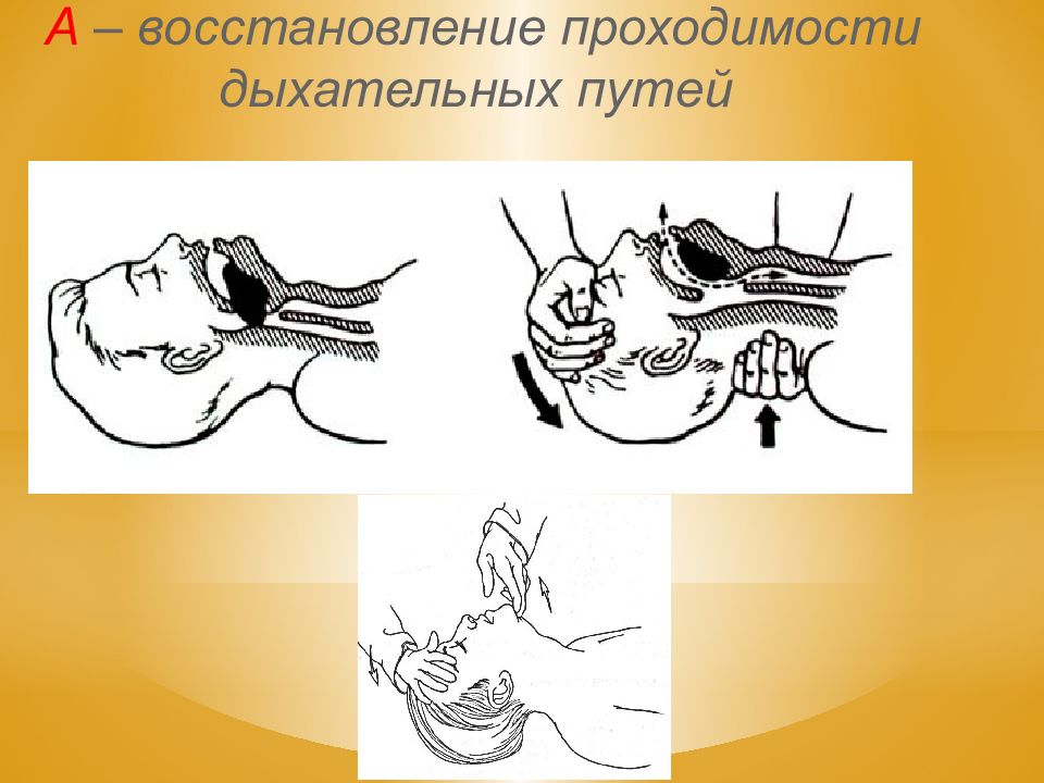 Восстановление проходимости дыхательных путей. Восстановление проходимости дыхательных путей фото. Приём Селика в анестезиологии. Инструменты для проходимости дыхательных путей. Анестезиология.