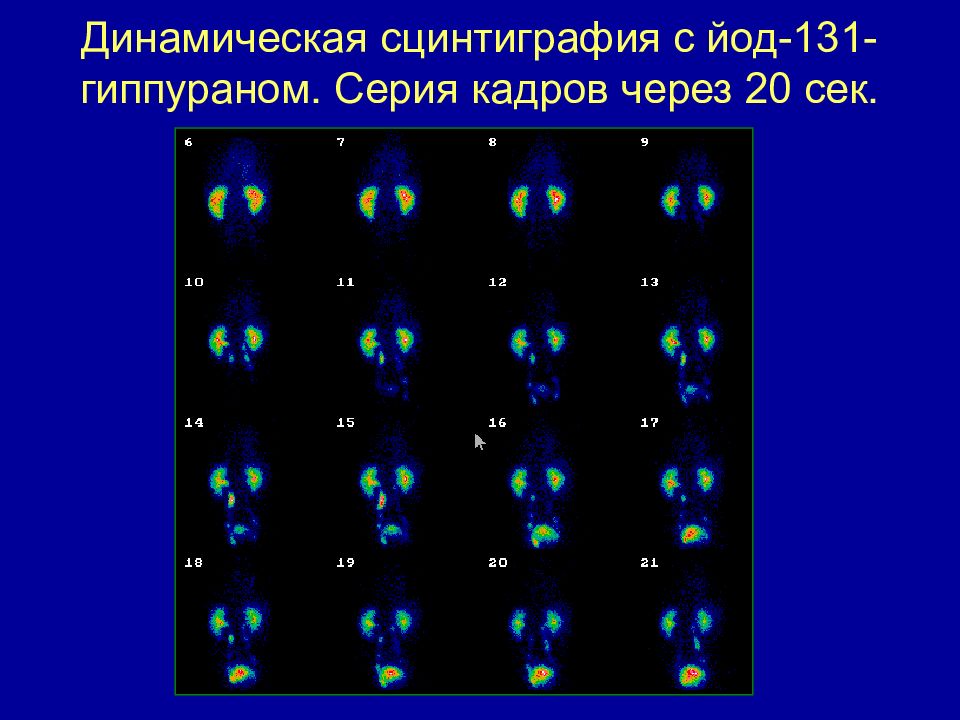 Что такое сцинтиграфия