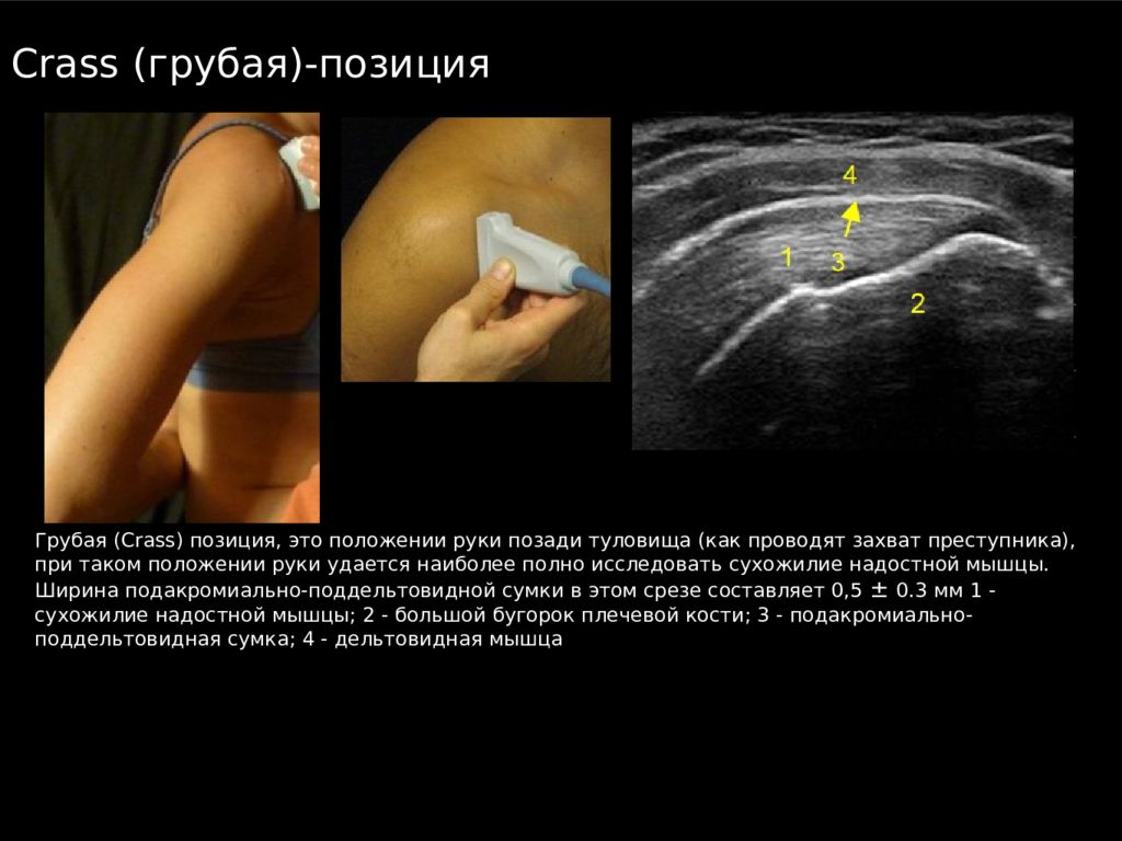 Узи плечевого. Ультразвуковое исследование плечевого сустава описанием. УЗИ плечевого сустава, протоколы, методика. УЗИ плечевого сустава норма. УЗИ мягких тканей плеча протокол.