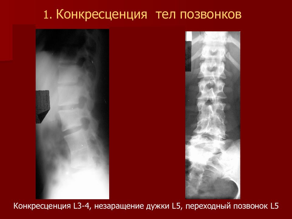 Конкресценция позвонков. Конкресценция тел с4-с5 позвонков. Конкресценция тел позвонков с1-с2. Частичная конкресценция тел позвонков с5/с6. Неполная конкресценция с2-с3.