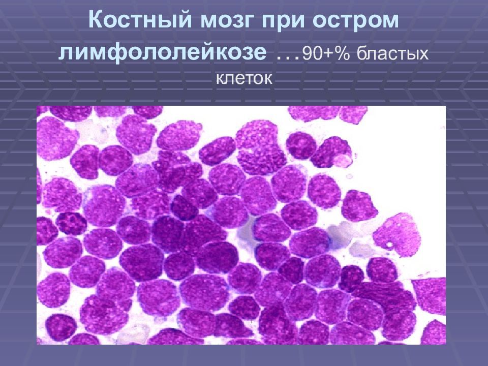 Гемобластозы патологическая анатомия презентация