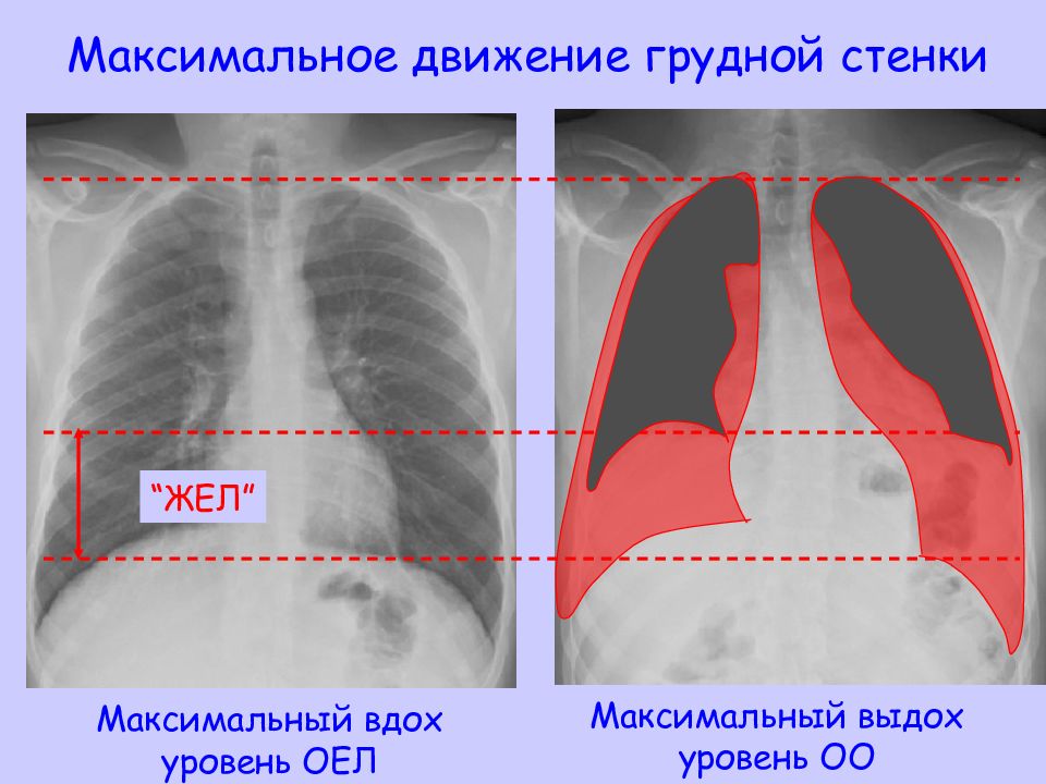 Максимальное движение. Максимальный вдох. Значительная и ассиметричная гепертрафия стенок желудрчков.