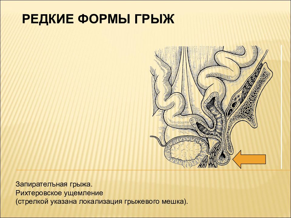 Презентация по грыжам живота