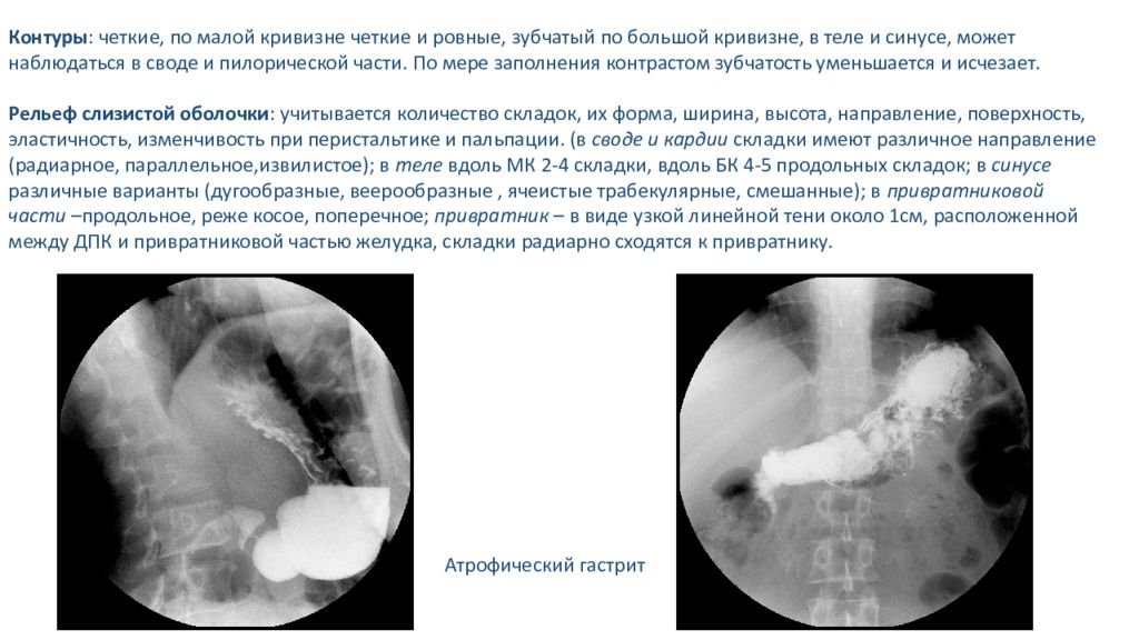 Скопия пищевода. Скопия желудка рентген протокол. Затек контрастного вещества на Скопии.
