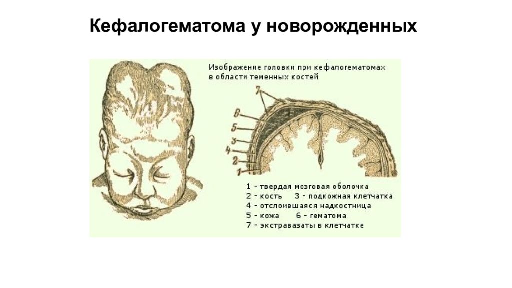 Картинки родовая опухоль