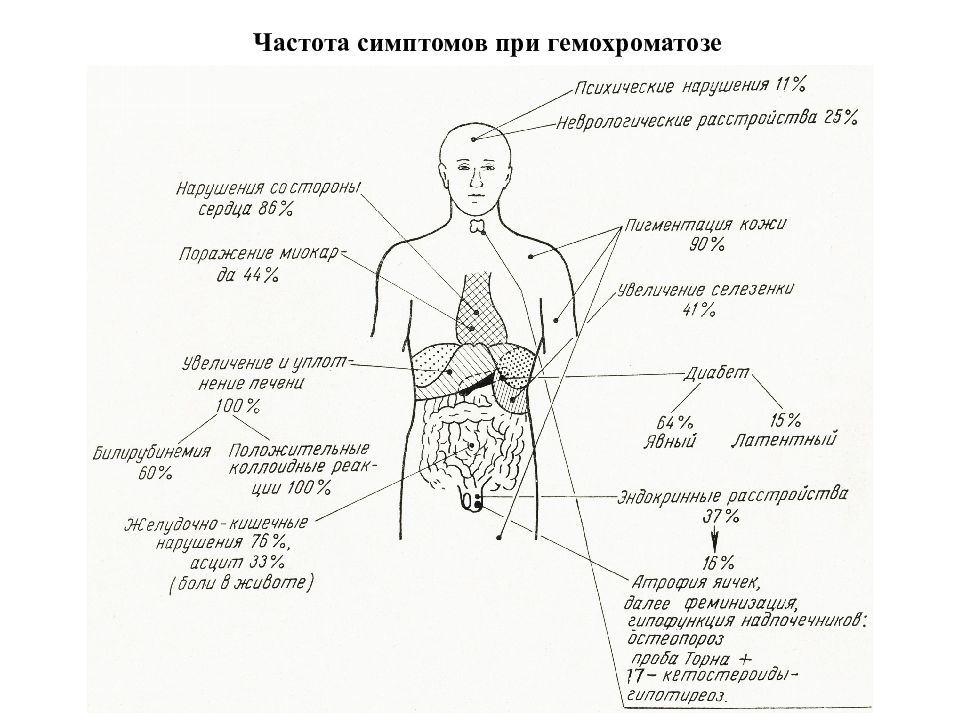 Гемохроматоз симптомы. Симптомы гемохроматоза. Гемохроматоз этиология патогенез. Гемохроматоз клинические симптомы.