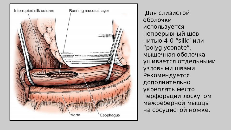 Торакальная хирургия презентация