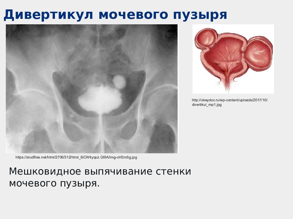 Пороки развития мочевого пузыря и уретры презентация