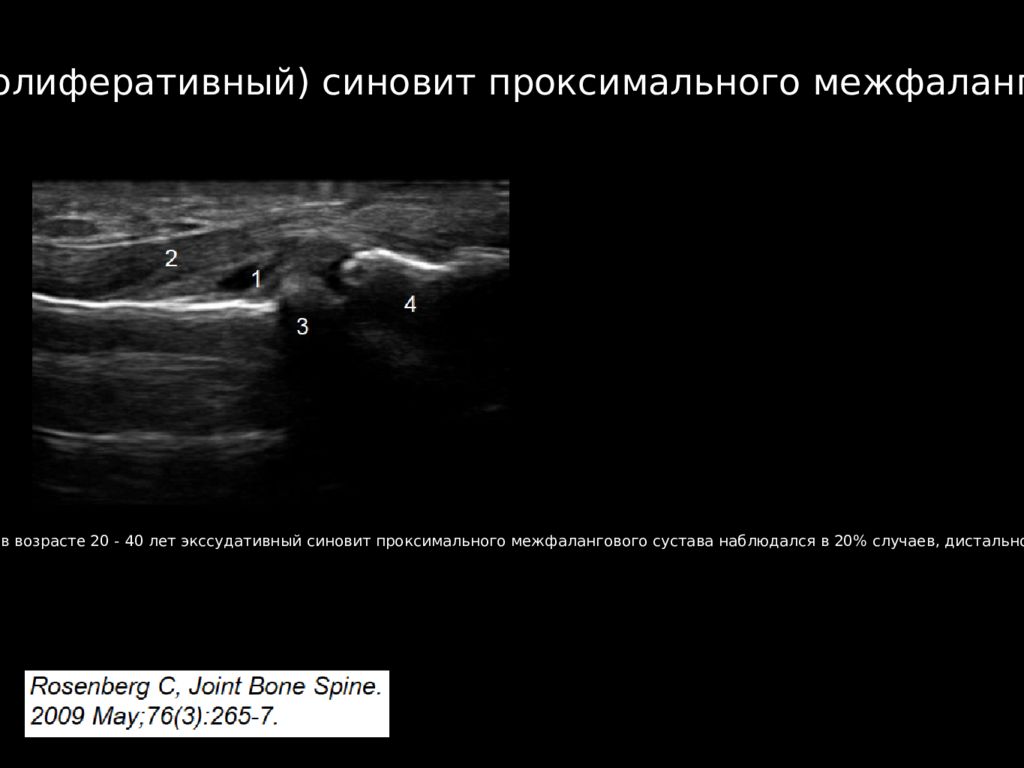 Пролиферативный синовит мрт. Пролиферативный синовит коленного сустава. Синовит проксимальных межфаланговых суставов.