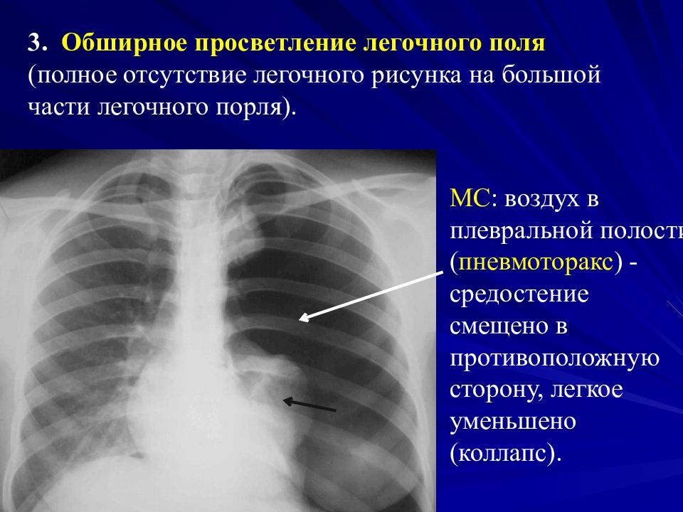 Просветление в легких. Тотальный пневмоторакс. Правосторонний пневмоторакс. Обширное просветление легочного поля. Пристеночный пневмоторакс.