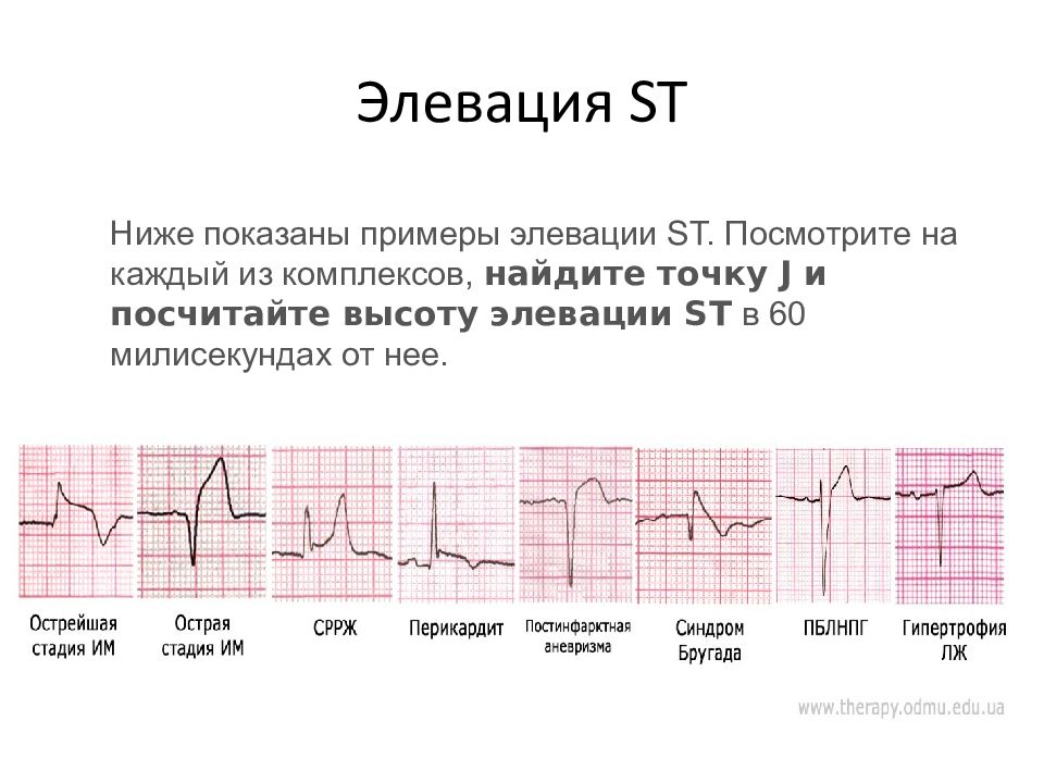 Без подъема st на экг. Подъем сегмента St на ЭКГ на 3 мм. ЭКГ при инфаркте миокарда с подъемом St. Элевация сегмента St на ЭКГ. Подъем сегмента St на ЭКГ v1 v2.