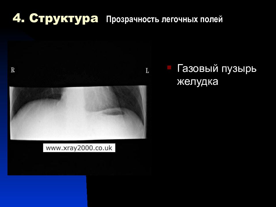 Легочное поле повышенной прозрачности. Газовый пузырь желудка на рентгене. Прозрачность легочных полей. Увеличен газовый пузырь желудка.