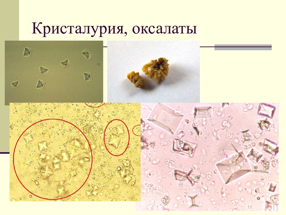 Оксалаты в моче картинки