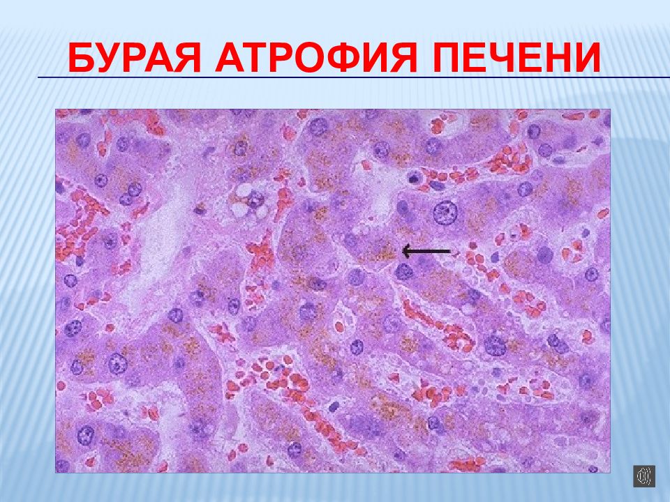 Презентация смешанные дистрофии