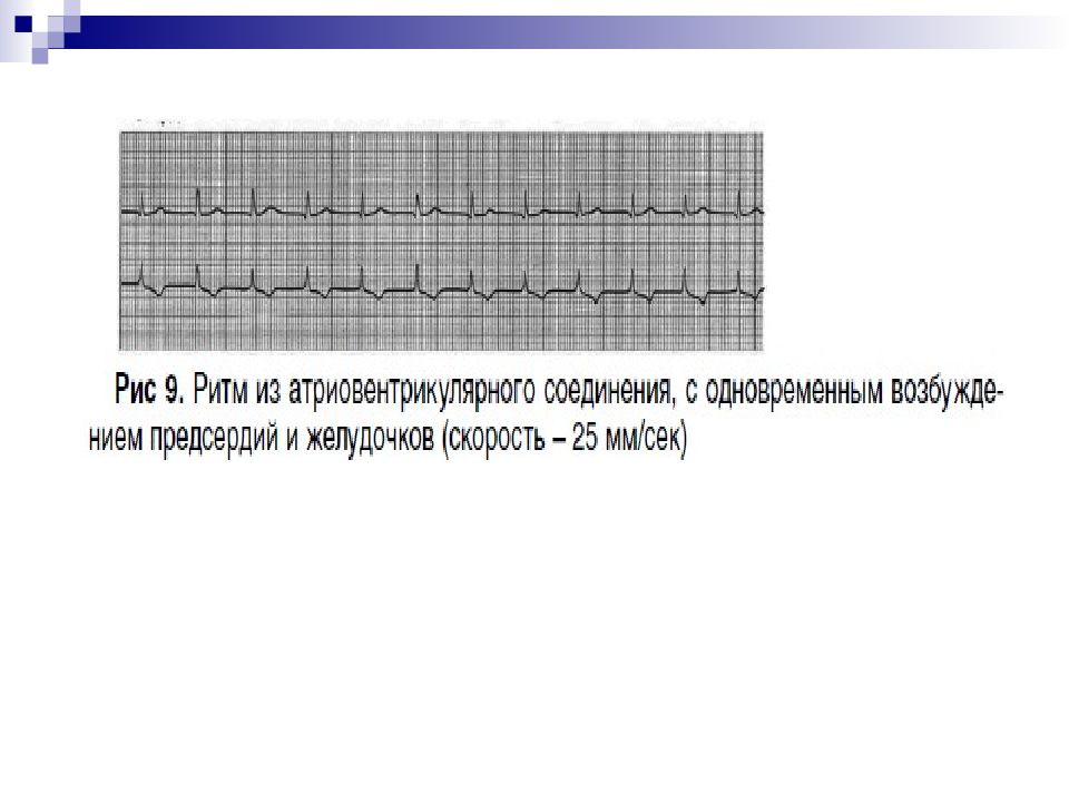 Ритм из ав соединения. Эктопические комплексы на ЭКГ. АВ ритм с предшествующим возбуждением желудочков. Эктопический ритм из АВ соединения на ЭКГ.