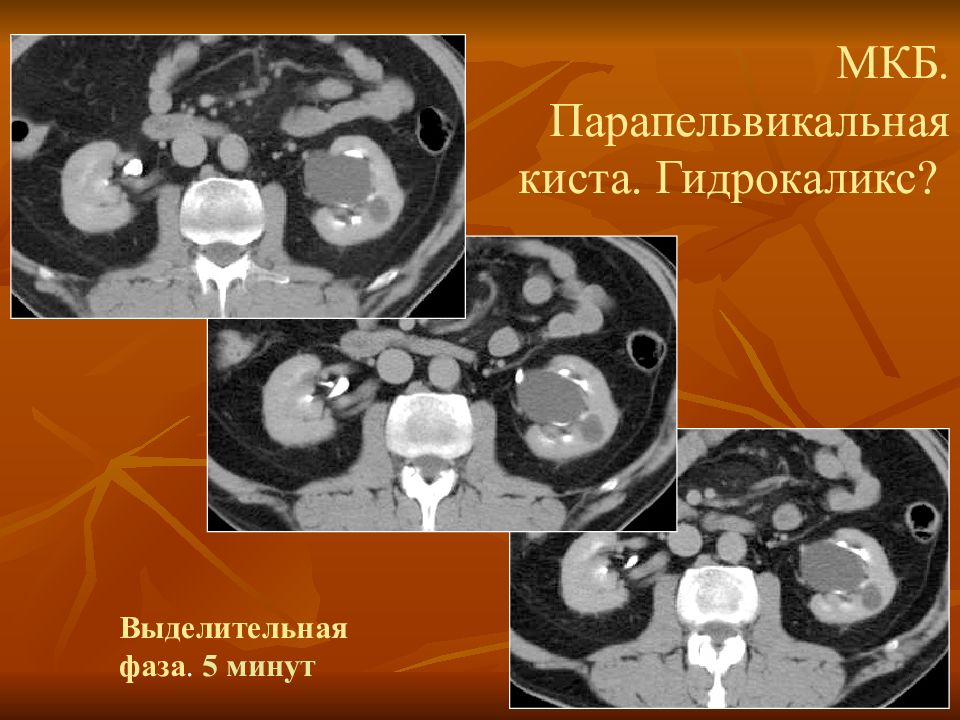 Парапельвикальные кисты почек