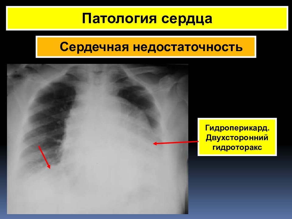 Гидроперикард. Двухсторонний гидроторакс. Гидроторакс и гидроперикард. Гидроперикард рентген.