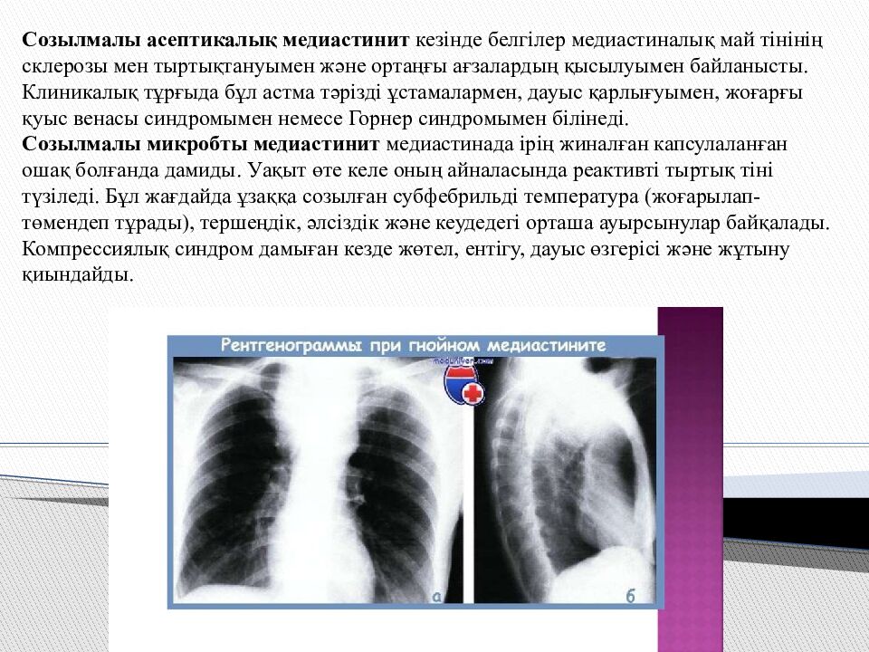Тақырыбы: Іріңді медиастинит