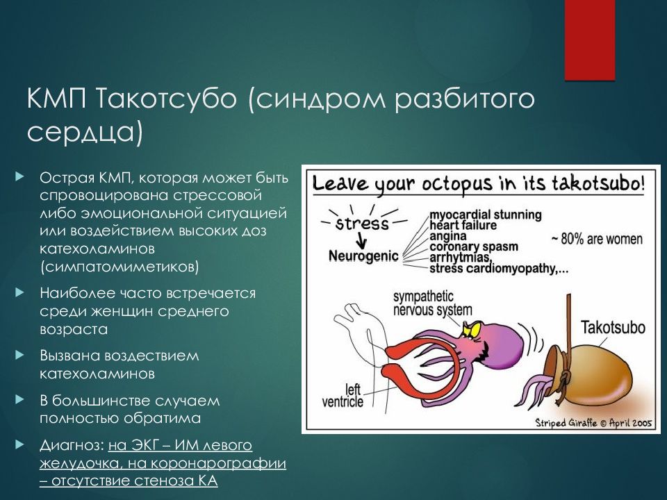 Кардиомиопатия такоцубо клинические рекомендации 2020. Синдром разбитого сердца симптомы. Синдром разбитого сердца симптомы. Кмп такоцубо на экг. Синдром разбитого сердца такоцубо экг.