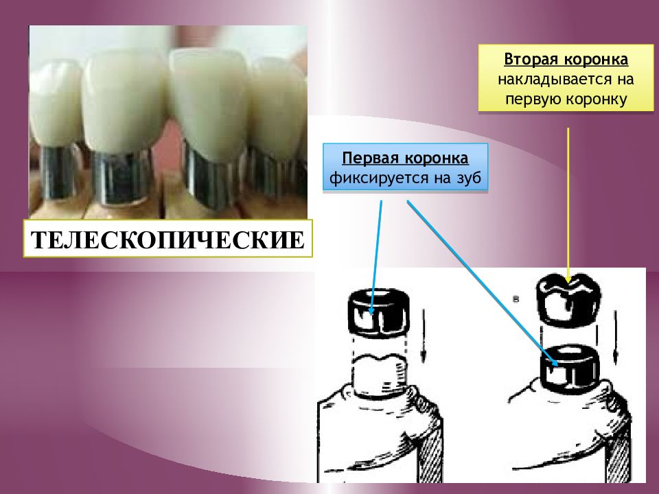 Искусственные коронки презентация