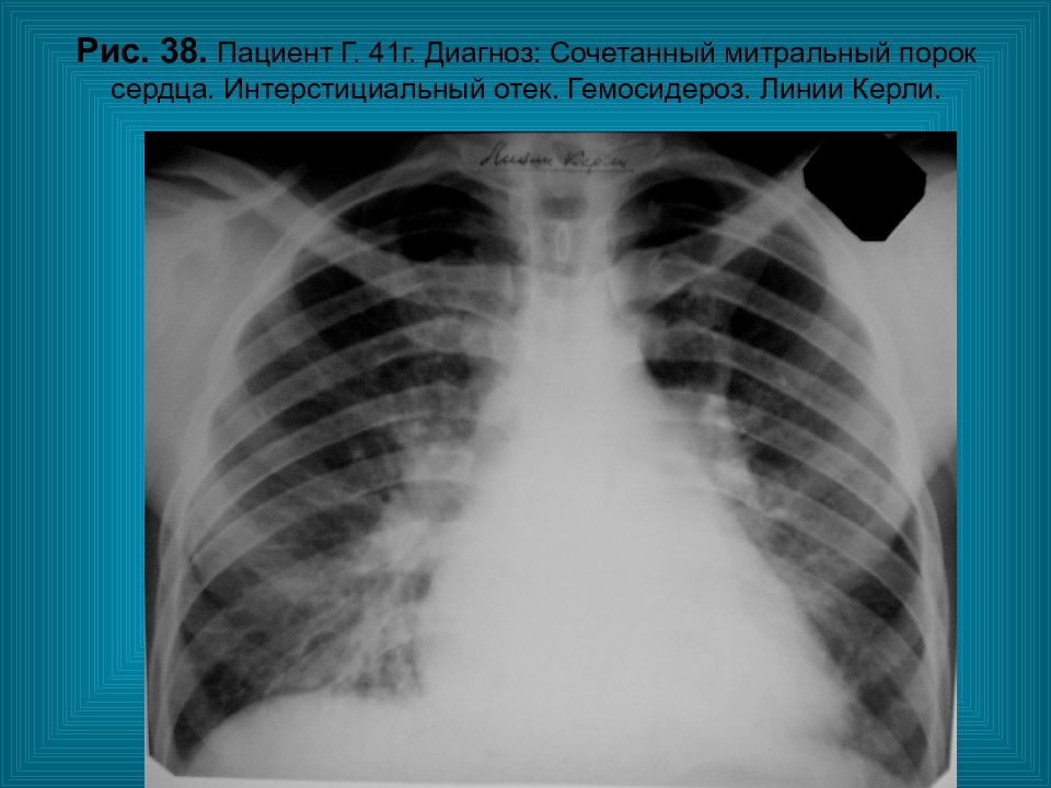 Диагноз г 5. Линии Керли на рентгенограмме и очаг гемосидероза. Линии Керли рентген. Гемосидероз легких рентген. Линии Керли типа в на рентгене.