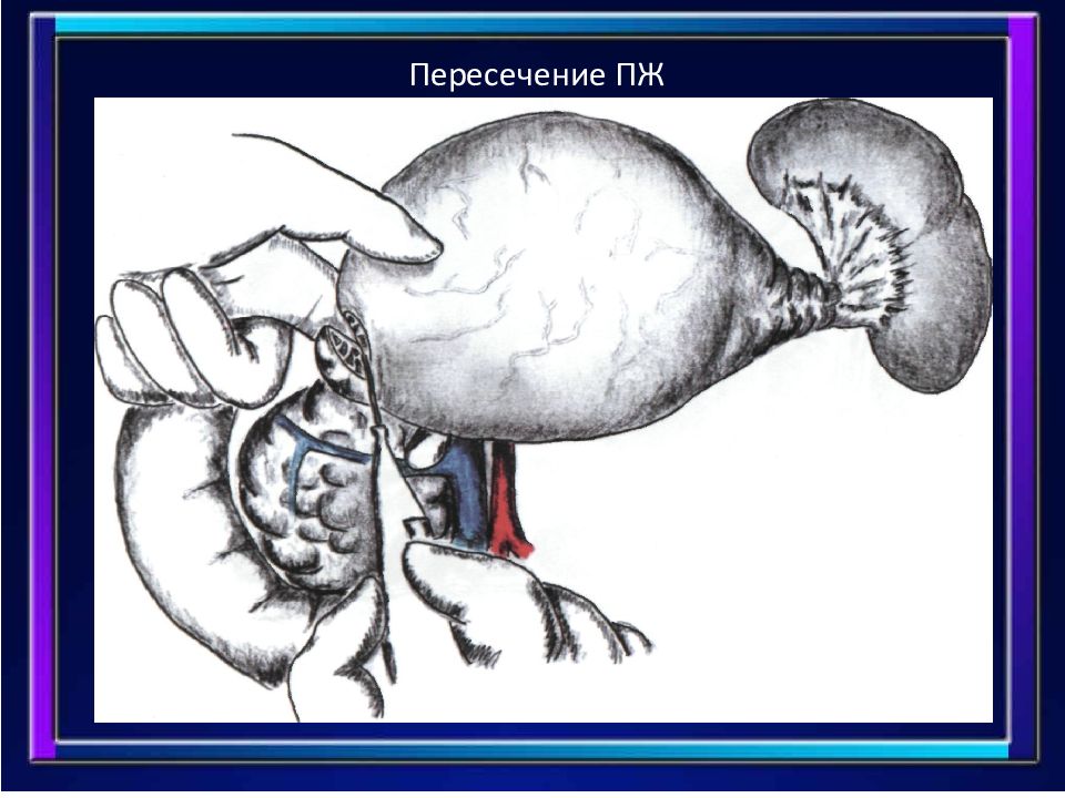 Пж19. Агенезия хвоста поджелудочной железы. Рисунки пж. Пж картинка. Тотальный краниорахисхиз.