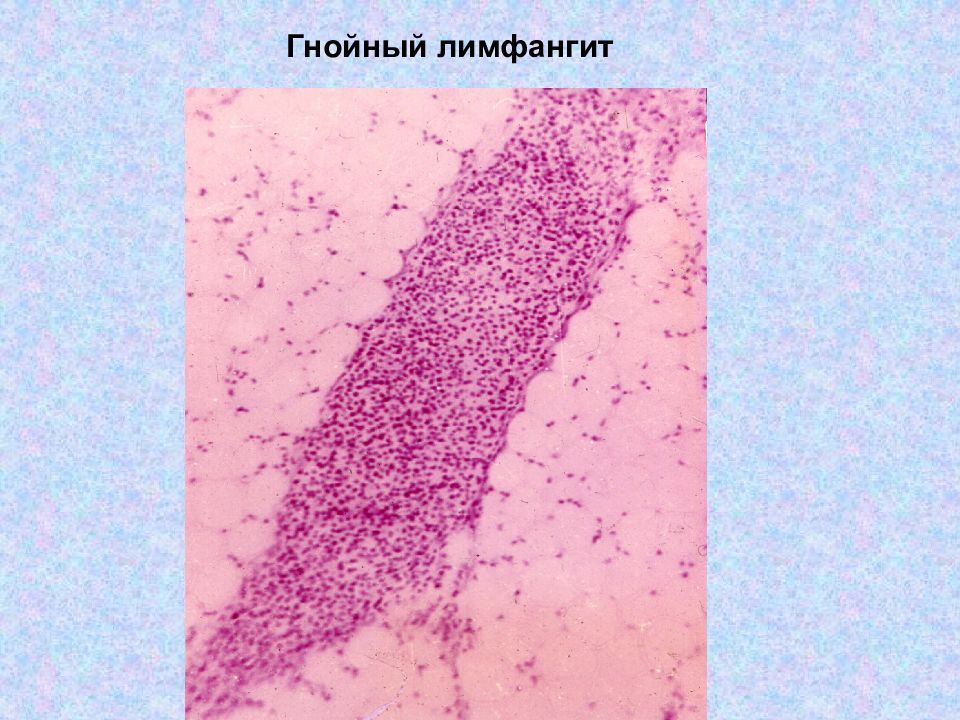 Чума патологическая анатомия презентация