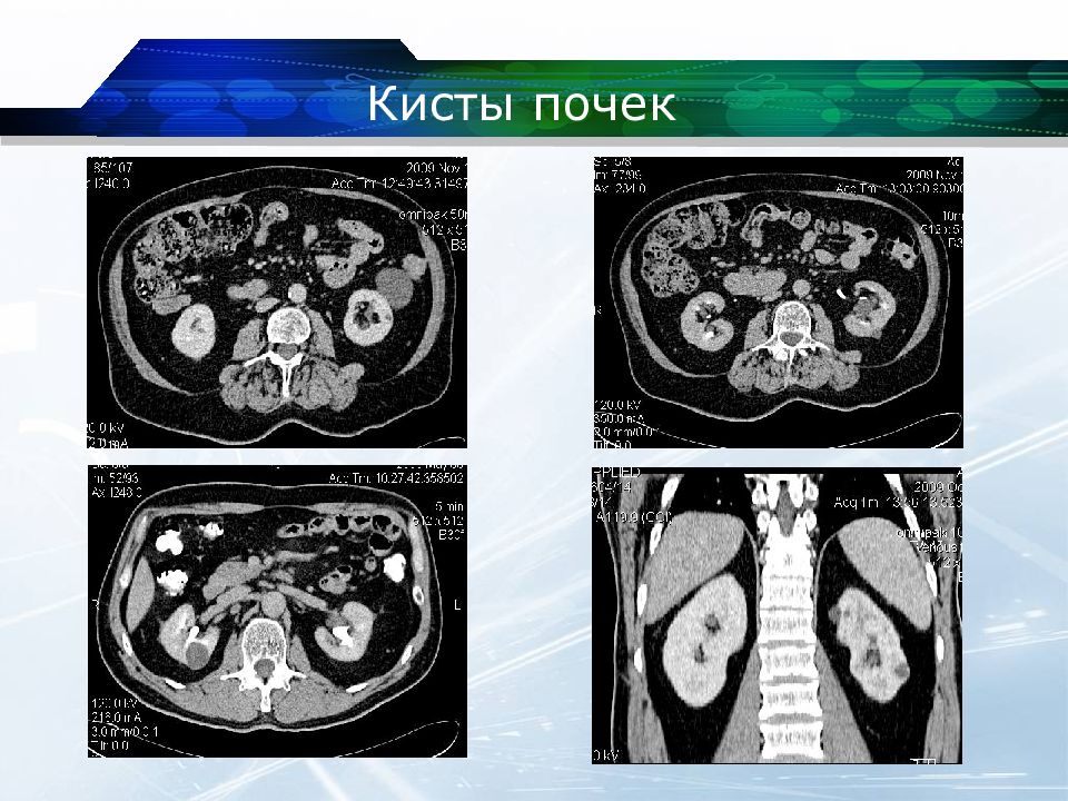 Типы кисты почек. Гиперденсная киста почки кт. Экстраренальная киста почки кт. Многокамерная киста почки на кт.