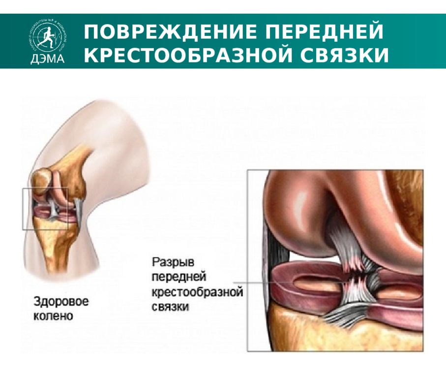 Повреждение коленного сустава презентация