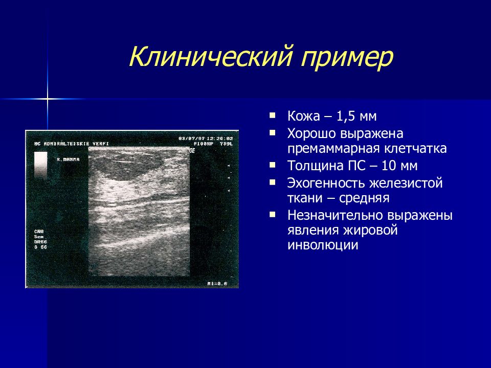 Узи молочной железы на какой. Ультразвуковая анатомия молочных желез. УЗИ анатомия молочной железы. Толщина железистого слоя молочной железы на УЗИ.