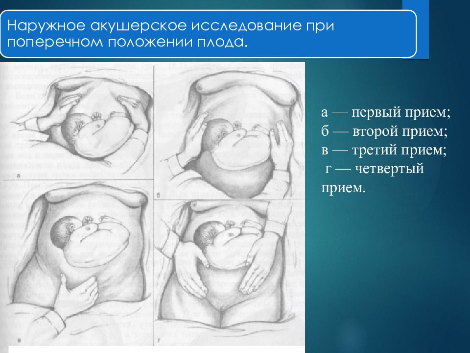 Предлежание плода картинки