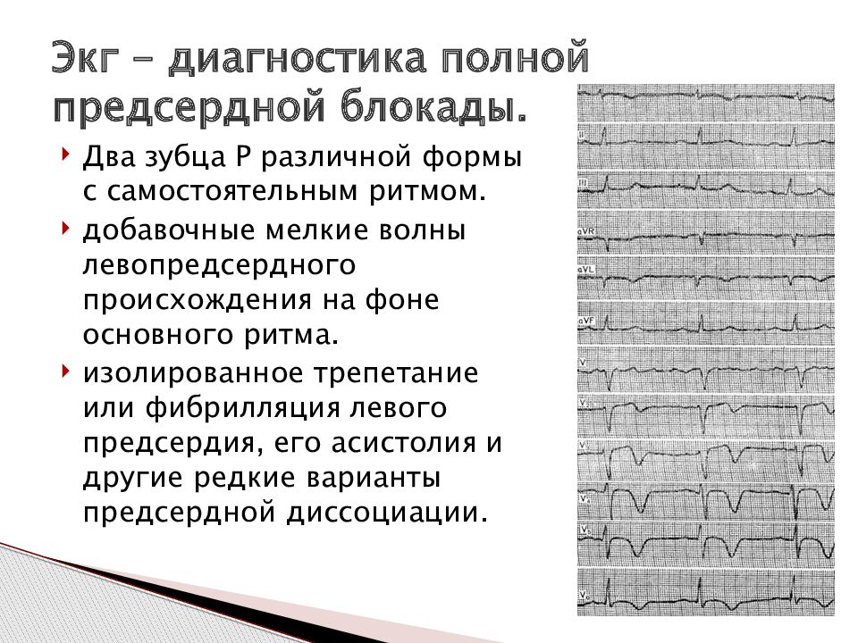 Нарушения проводимости презентация