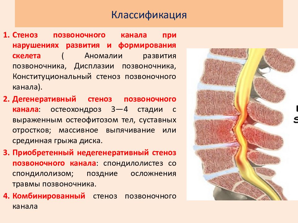 Стеноз позвоночного канала поясничного отдела