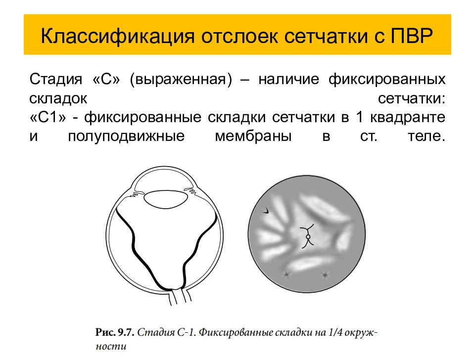 Презентация на тему отслойка сетчатки