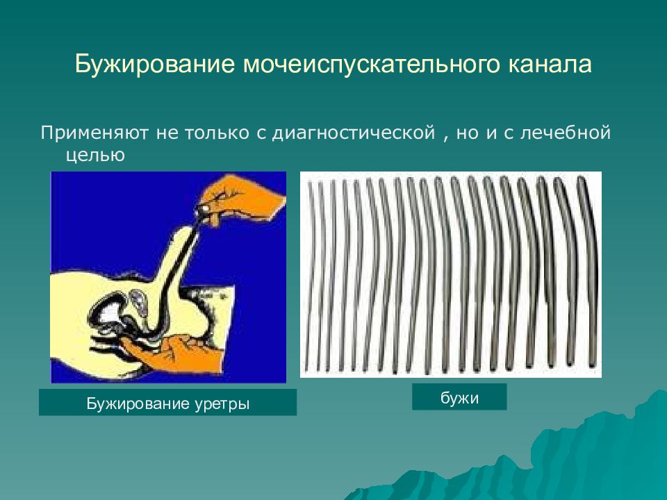 бужирование уретры у мужчин что это такое. бужирование уретры катетер. набор для бужирования пищевода. инструмент для бужирования уретры. бужирование уретры у мужчин что это такое.