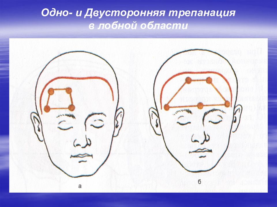 Трепанация лобной области. Операция в области головы.