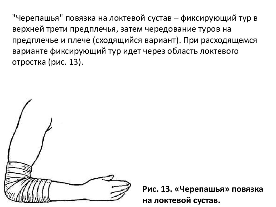 Перевязка локтя. Черепашья повязка на локтевой сустав расходящаяся. Черепашья повязка на локтевой сустав. Перевязка черепашья на локтевой сустав. Техника наложения черепашьей повязки на локтевой сустав.