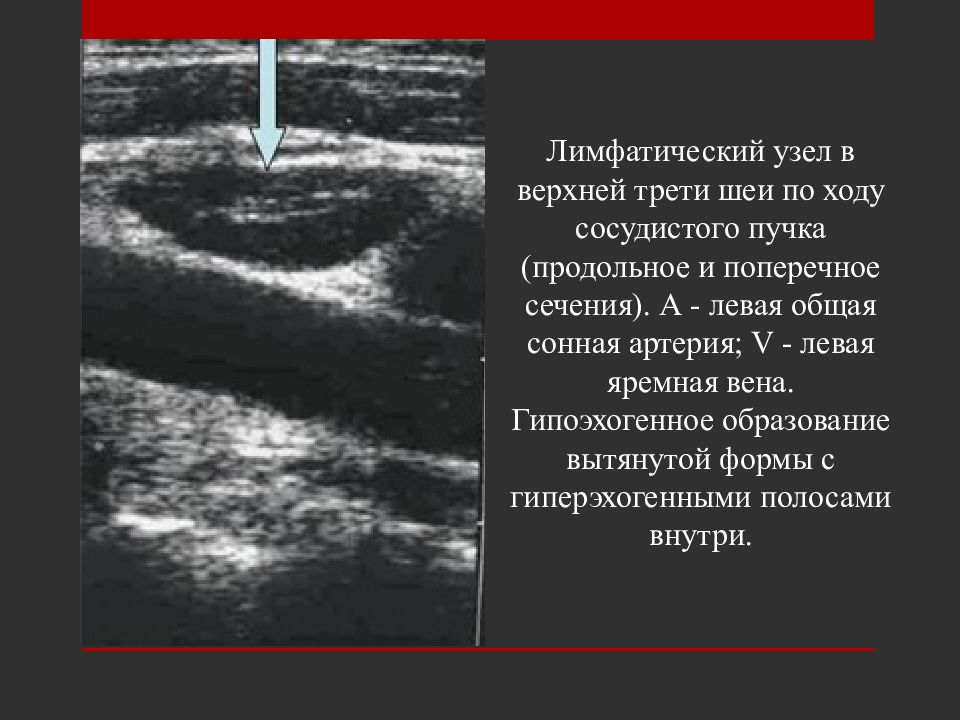 Узи лимфатических узлов. УЗИ заушных лимфатических узлов. УЗИ лимфатических узлов норма. Нормальные лимфатические узлы на УЗИ. Зона лимфатических узлов на УЗИ.