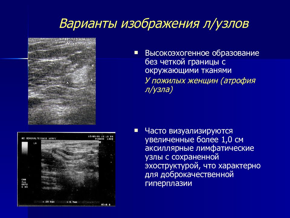 Аксиллярный лимфоузел молочной железы что это такое. Ультразвуковая анатомия молочной железы. Узел молочной железы на УЗИ. УЗИ анатомия молочных желез. УЗИ анатомия молочной железы.