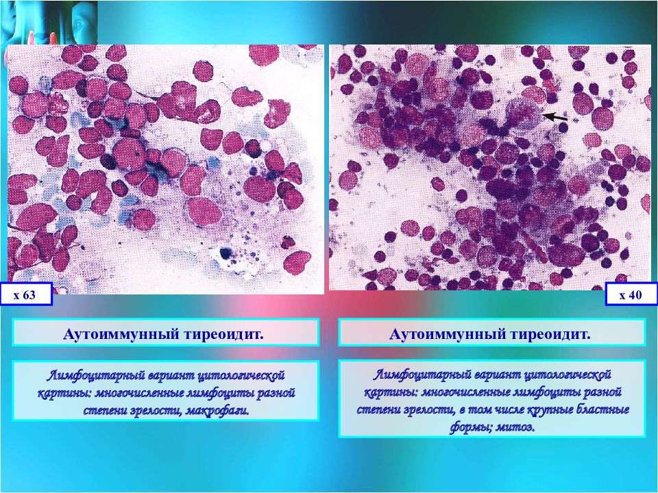 Цитологическая картина. Аутоиммунный тиреоидит цитология. Цитологическая картина АИТ. Тиреоидит Хашимото цитология. Патология щитовидной железы цитология.