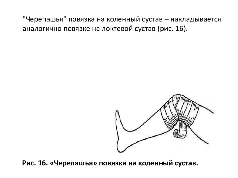 Наложение черепашьей повязки на коленный сустав. Расходящаяся черепашья повязка на область коленного сустава. Черепашья повязка на коленный сустав алгоритм. Черепашья сходящаяся на коленный сустав повязка.