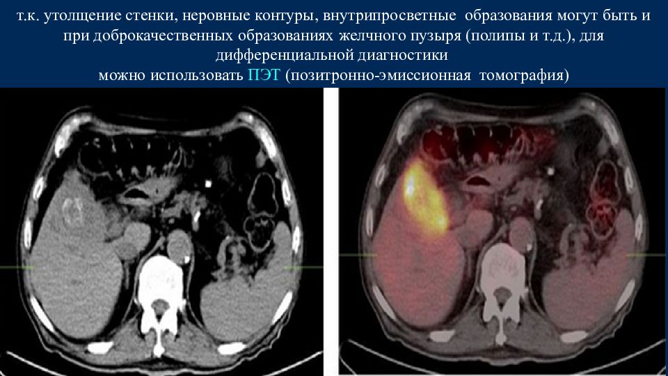 Рак желчного. Внутрипросветное образование. Неровные контуры стенки желчного пузыря. Внутрипросветные образования в желчном пузыре. Утолщение стенки желчного пузыря кт.