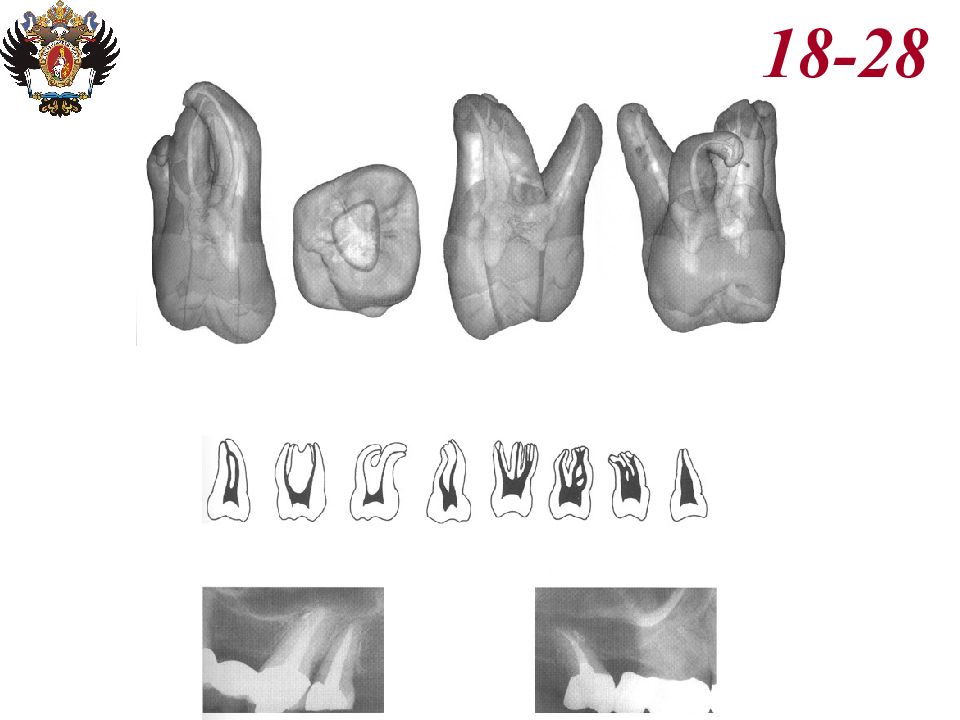 Анатомия каналов. 26 Зуб анатомия корневых каналов. 27 Зуб анатомия корневых каналов. 17 Зуб анатомия корневых каналов.