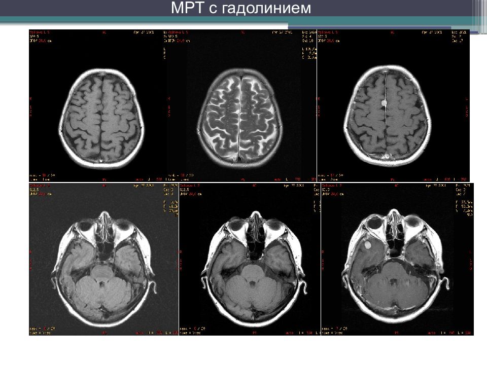 Контраст для мрт. Гадолиний контраст для мрт. Контрастные препараты для мрт. Мрт с контрастом.